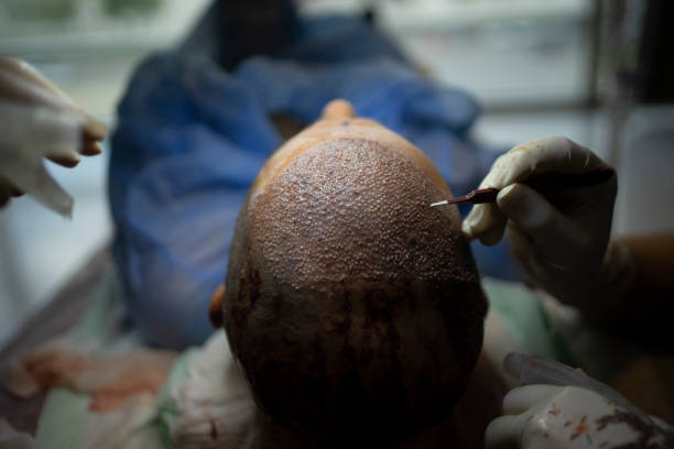 Hair Transplant Procedure Market by Procedure (Follicular Unit Extraction and Follicular Unit Transplant), by Gender (Male and Female), by End User (Hospitals, Clinics and Surgical Centers), - Global Outlook & Forecast 2022-2030