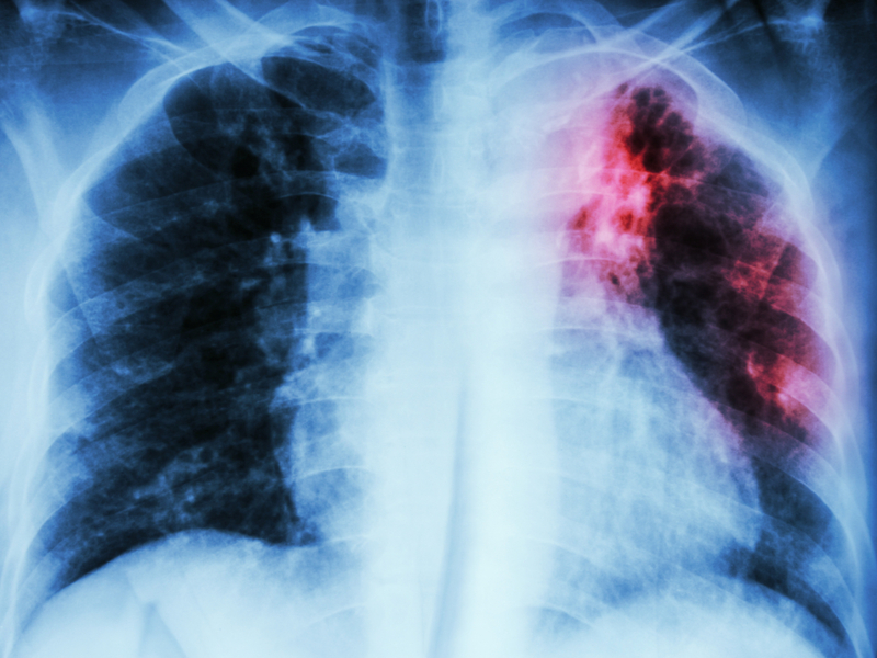 Tuberculosis (TB) Diagnostics Market by Type (Culture and Species Identification, Radiographic Test, Microscopy, Molecular Testing, Antigen Testing, Genetic Testing, and Drug Resistance Test) and by End User (Hospitals & Clinics and Diagnostic Laboratories) - Global Outlook & Forecast 2022-2030