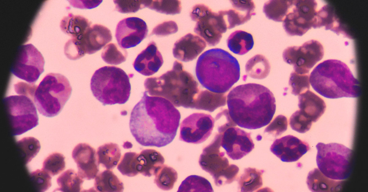 Acute Myeloid Leukemia Market by Drug Class (Antineoplastics, Kinase Inhibitors, Hedgehog Pathway Inhibitors, and Others) – Global Outlook & Forecast 2024-2032