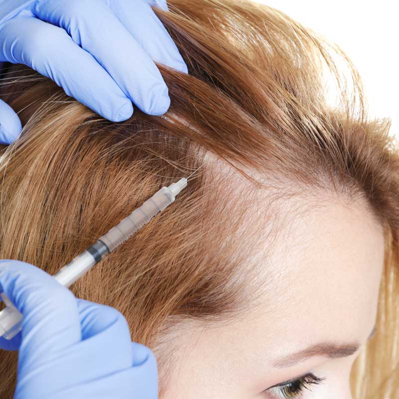 Alopecia Treatment Market by Drug Class (Corticosteroids, Finasteride, Minoxidil, Vasodilator, Others), Type (Female, Male), and Distribution Channel (Hospitals, Retail Pharmacies, Online Pharmacies) – Global Outlook & Forecast 2022-2030