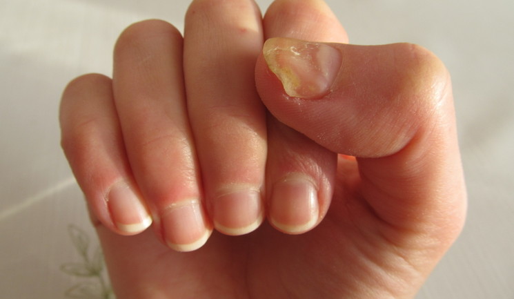 Onychomycosis Therapeutics Market by Indication Type (Distal Subungual Onychomycosis, Proximal Subungual Onychomycosis), Treatment Type (Photodynamic Therapy, Drug Treatment), Distribution Channel (Hospital Pharmacies, Retail Pharmacies) - Global Outlook and Forecast 2024-2032