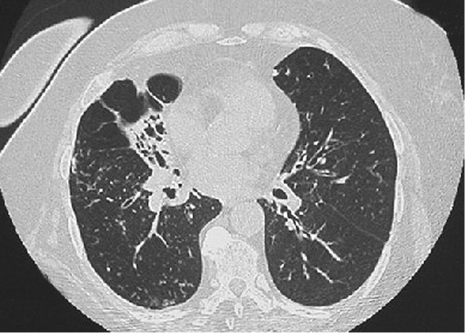 Bronchiolitis Obliterans Syndrome Market by Treatment Type (Corticosteroids, Inhaled Cyclosporine and Others), by Distribution Channel (Hospital, Retail and Online Pharmacies) – Global Outlook & Forecast 2022-2030