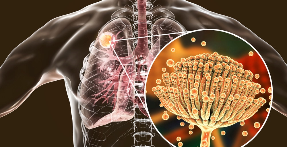 Chronic Pulmonary Aspergillosis Drugs Market by Drug Class (Azole Antifungals, Antibiotics, and Others), by Route of Administration (Oral, and Parenteral) - Global Outlook & Forecast 2022-2030