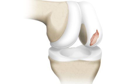 Cartilage Repair Market by Modality (Cell Based (Growth Factor Technology, Chondrocyte Transplantation), Non-Cell Based (Tissue Scaffold, Cell-Free Composites)), by Treatment Type (Palliative (Debridement & Lavage, Viscosupplementation), Intrinsic Repair Stimulus)), by Application (Fibrocartilage, Hyaline Cartilage) – Global Outlook & Forecast 2022-2030