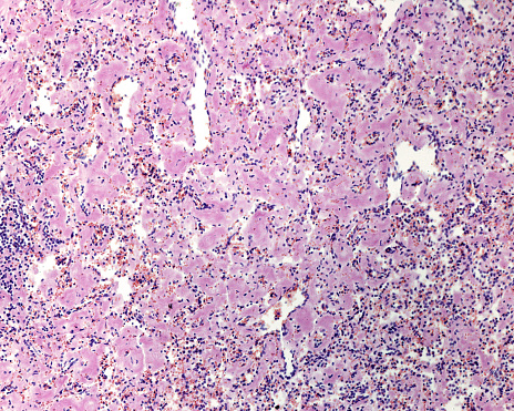 Transthyretin Amyloidosis (ATTR) Therapeutics Market by Disease Type (Familial and Wild Type), Drug Class (siRNA Agents, Antisense Oligonucleotides, Transthyretin Stabilizers), Distribution Channel (Hospitals) – Global Outlook & Forecast 2022-2030