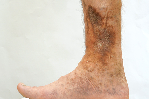 Global Venous Leg Ulcer (VLU) Treatment Market by Product (Advanced Wound Dressing, Compression Therapy), stage of disease (Stage I, Stage II), End-user (Hospitals & Clinics, Home Care Settings) – Global Outlook & Forecast 2022-2030