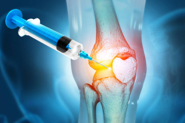 Knee Osteoarthritis Therapeutics Market by Drug Type (NSAIDs, Viscosupplement Agents), Distribution Channel (Hospital Pharmacy, Retail Pharmacy) – Global Outlook & Forecast 2022-2030