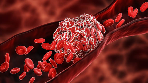 Thrombosis Associated with Cancer Market by Drug Class (Heparin, Vitamin K Antagonist, Factor Xa Inhibitors, Direct Thrombin Inhibitors), by Indication (Venous Thromboembolism, Arterial Thrombosis) – Global Outlook & Forecast 2022-2030