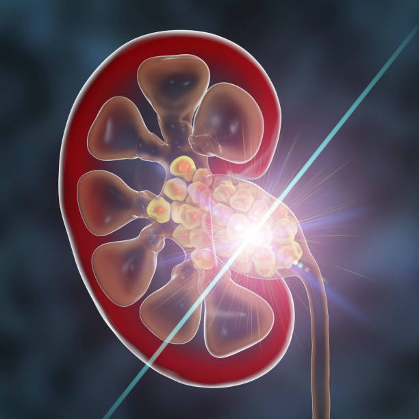 Urology Lasers Market by Type (Holmium Laser System, Diode Laser System, and Thulium Laser System), Application (Benign Prostatic Hyperplasia, Urolithiasis, and Non-muscle-invasive Bladder Cancer) – Global Outlook & Forecast 2022-2030