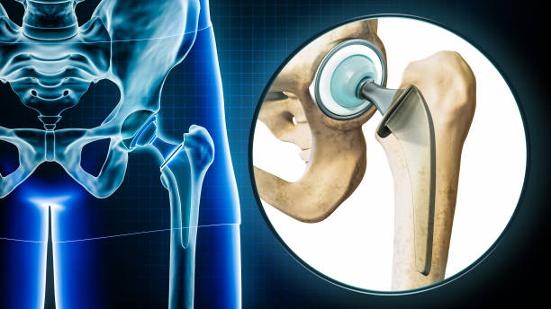 Orthopedic Joint Replacement Market by Product, (Knee, Hip, Ankle), Procedure (Total Replacement, Partial Replacement) – Global Outlook & Forecast 2022-2030