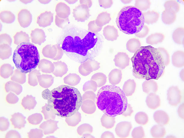Large Granular Lymphocytic Leukemia Market by Drug Class (Antineoplastic, Immunosuppressants, Alkylating Agents) and Distribution Channel (Hospital Pharmacies, Retail Pharmacies) – Global Outlook & Forecast 2023-2031