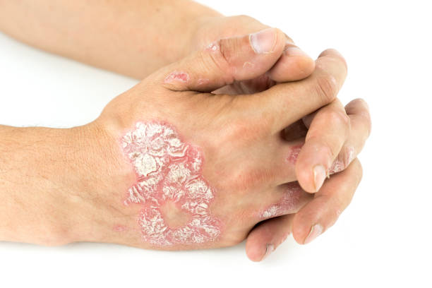 Plaque Psoriasis Market by Drug Class (Interleukin Inhibitors, TNF-Inhibitors, Corticosteroids), Route of Administration (Oral, Topical, Parental), Distribution Channel (Hospital Pharmacies, Retail Pharmacies, Online Pharmacies) – Global Outlook & Forecast 2023-2031
