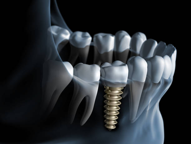 Titanium Dental Implant Market by Product (Endosteal, Subperiosteal), Procedure (Two-stage, Single-stage), End-user (Hospitals & Clinics, Dental Laboratories) - Global Outlook and Forecast 2023-2031