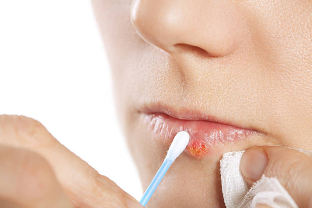 Herpes Simplex Virus Treatment Market by Type (Herpes Simplex Virus 1, Herpes Simplex Virus 2), Drug Type (Famciclovir, Acyclovir), and Route of Administration (Topical, Oral) - Global Outlook & Forecast 2023-2031