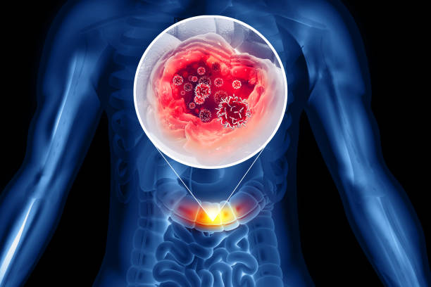 Metastatic Colorectal Cancer Therapeutics Market by Treatment Regime (Monotherapy and Combination Therapy), Therapy (Chemotherapy, Targeted Therapy), End User (Hospitals, Cancer Centers) â€“ Global Outlook & Forecast 2023-2031