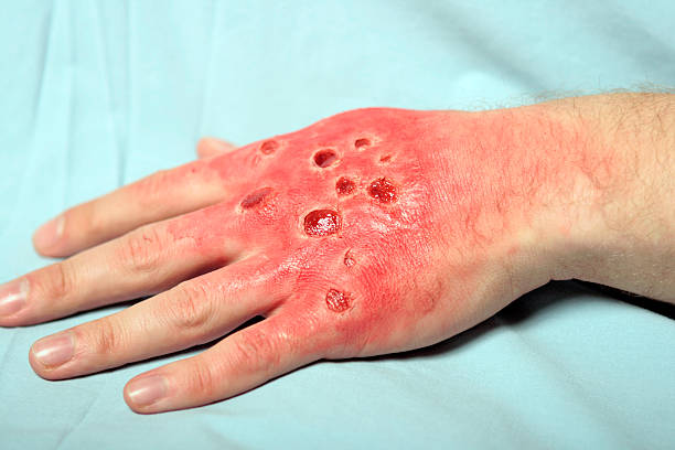 Pemphigus Vulgaris Market by [Diagnosis (Histopathology, Direct Immunofluorescence), Treatment (Corticosteroids)], Route of Administration (Oral, Parenteral), Distribution Channel (Hospital Pharmacies) – Global Outlook & Forecast 2023-2031