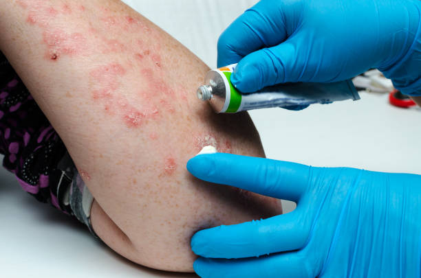 Erythema Treatment Market by Drug Type (Antibiotics, Antifungal, Antihistamines, Corticosteroids, Others), Distribution Channel (Hospital, Retail and Online Pharmacy) – Global Outlook & Forecast 2023-2031