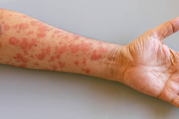 Histiocytosis Treatment Market by Type (Langerhans Cell Histiocytosis, Hemophagocytic Lymphohistiocytosis), Therapy (Pharmacological Therapy, Chemotherapy) – Global Outlook & Forecast 2023-2031