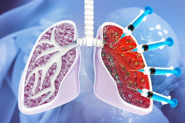 Hypersensitivity Pneumonitis Market by Type (Sub-acute Hypersensitivity Pneumonitis, Acute Hypersensitivity Pneumonitis), Treatment (Immunosuppressive, Corticosteroids) – Global Outlook & Forecast 2023-2031