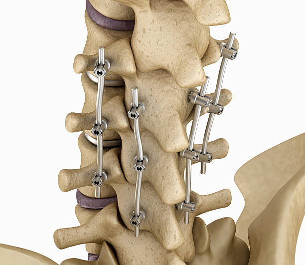 Intervertebral Implants Market by Тype (Lumbar, Cervical), Material (Titanium, PEEK) – Global Outlook & Forecast 2023-2031